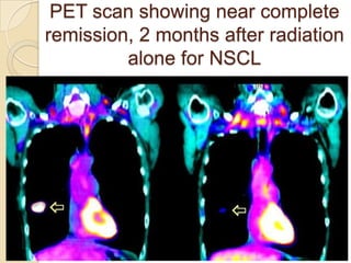 PET scan showing near complete
remission, 2 months after radiation
         alone for NSCL
 