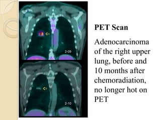 PET Scan

 2-09
        Adenocarcinoma
        of the right upper
        lung, before and
        10 months after
        chemoradiation,
2-10    no longer hot on
        PET
 