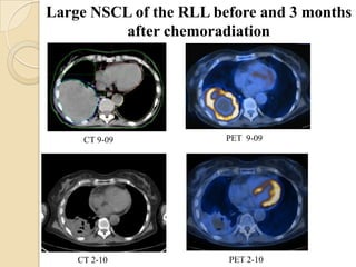 Large NSCL of the RLL before and 3 months
          after chemoradiation




     CT 9-09            PET 9-09




    CT 2-10             PET 2-10
 