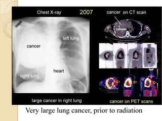 Very large lung cancer, prior to radiation
 