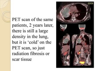 PET scan of the same
patients, 2 years later,
there is still a large
density in the lung,
but it is ‘cold’ on the
PET scan, so just
radiation fibrosis or
scar tissue
 