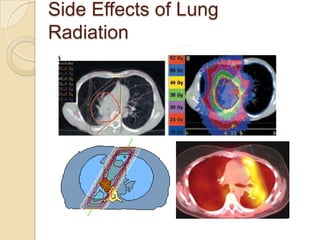Side Effects of Lung
Radiation
 