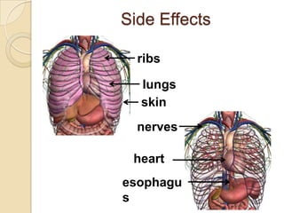 Side Effects

  ribs

  lungs
  skin
  nerves

 heart
esophagu
s
 