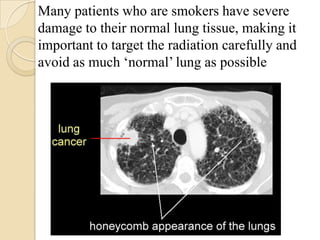 Many patients who are smokers have severe
damage to their normal lung tissue, making it
important to target the radiation carefully and
avoid as much ‘normal’ lung as possible
 