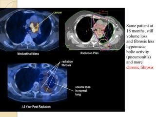 Same patient at
18 months, still
volume loss
and fibrosis less
hypermeta-
bolic activity
(pneumonitis)
and more
chronic fibrosis
 