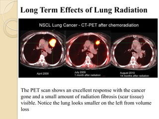 Long Term Effects of Lung Radiation




The PET scan shows an excellent response with the cancer
gone and a small amount of radiation fibrosis (scar tissue)
visible. Notice the lung looks smaller on the left from volume
loss
 