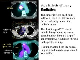 Side Effects of Lung
Radiation
The cancer is visible as bright
yellow on the first PET scan and
the second image shows the
radiation zone
The third image (PET scan 4
months later) shows the cancer
gone, but now there is a strip of
abnormal tissue / radiation fibrosis
in the posterior lung.
It is important to keep the normal
lung exposed to radiation as small
as possible
 