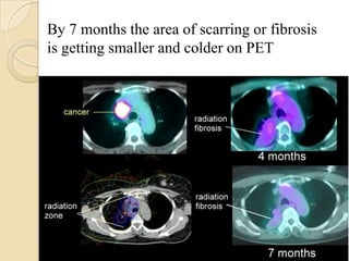 By 7 months the area of scarring or fibrosis
is getting smaller and colder on PET
 