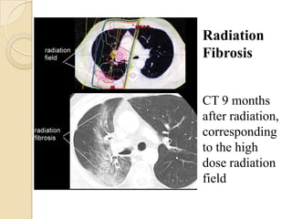 Radiation
Fibrosis


CT 9 months
after radiation,
corresponding
to the high
dose radiation
field
 