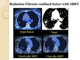 Radiation Fibrosis confined better with SBRT
 