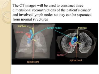The CT images will be used to construct three
dimensional reconstructions of the patient’s cancer
and involved lymph nodes so they can be separated
from normal structures
 