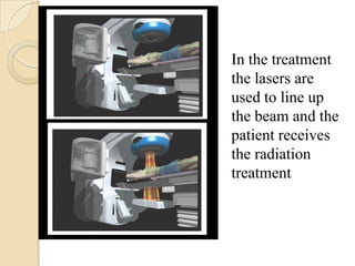 In the treatment
the lasers are
used to line up
the beam and the
patient receives
the radiation
treatment
 