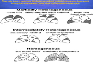 Emphysema Distribution Lung volume reduction surgery | PPTX