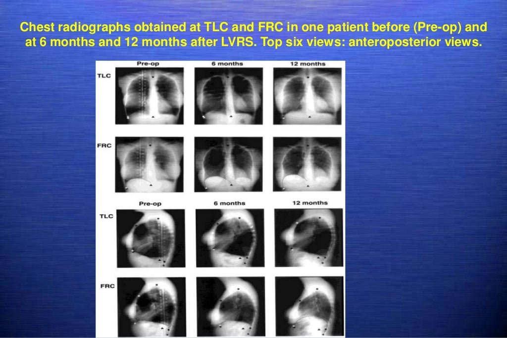 Lung volume reduction surgery