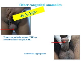 Other congenital anomalies
Transverse testicular ectopia (TTE), or
crossed testicular ectopia (CTE)
Subcoronal Hypospadias
 