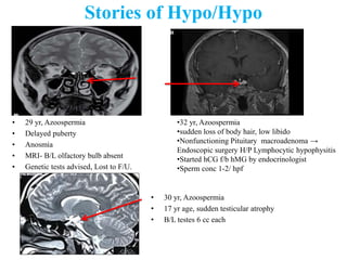 Stories of Hypo/Hypo
• 29 yr, Azoospermia
• Delayed puberty
• Anosmia
• MRI- B/L olfactory bulb absent
• Genetic tests advised, Lost to F/U.
•32 yr, Azoospermia
•sudden loss of body hair, low libido
•Nonfunctioning Pituitary macroadenoma →
Endoscopic surgery H/P Lymphocytic hypophysitis
•Started hCG f/b hMG by endocrinologist
•Sperm conc 1-2/ hpf
• 30 yr, Azoospermia
• 17 yr age, sudden testicular atrophy
• B/L testes 6 cc each
 