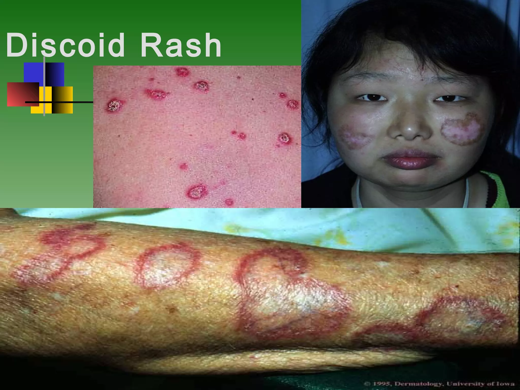 systemic lupus erythematosus | PPT