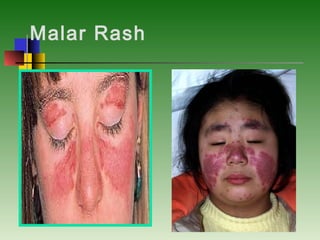 Malar Rash
 