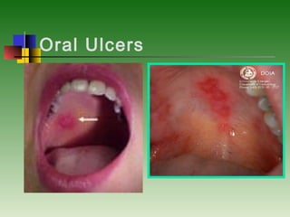 Oral Ulcers
 