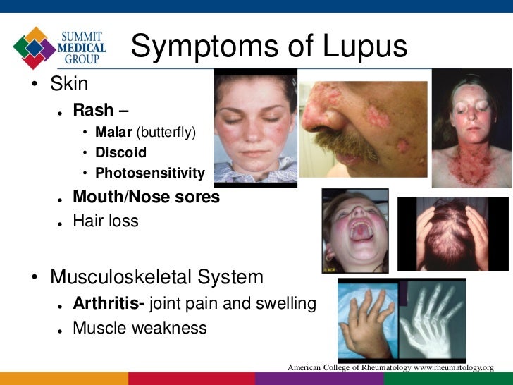 Lupus Rash On Nose