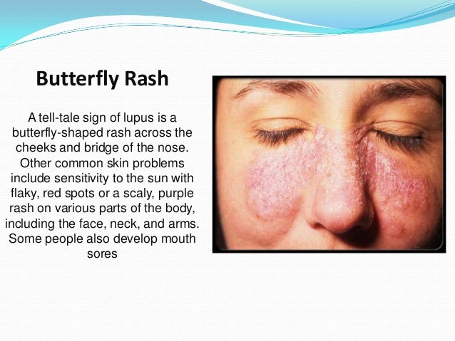 lupus and sun sensitivity