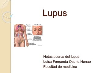 Lupus
Notas acerca del lupus
Luisa Fernanda Osorio Henao
Facultad de medicina