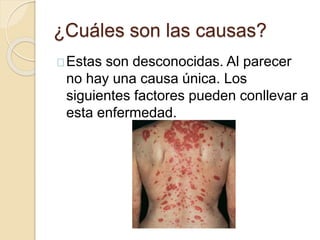 ¿Cuáles son las causas?
Estas son desconocidas. Al parecer
no hay una causa única. Los
siguientes factores pueden conllevar a
esta enfermedad.