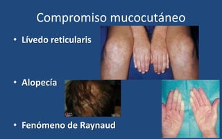• Lívedo reticularis
• Alopecía
• Fenómeno de Raynaud
Compromiso mucocutáneo
 