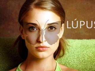 Lupus