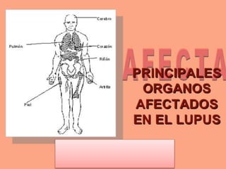 Lupus
