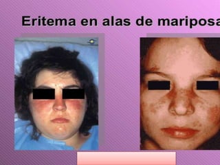 Lupus