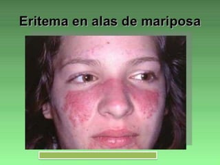 Lupus