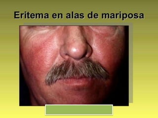 Lupus