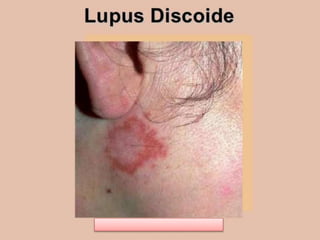 Lupus