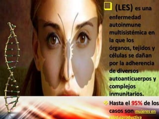 Lupus