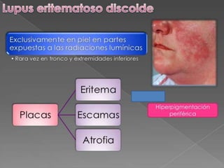 Lupus