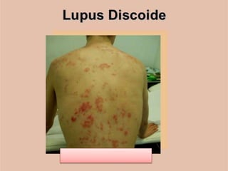 Lupus