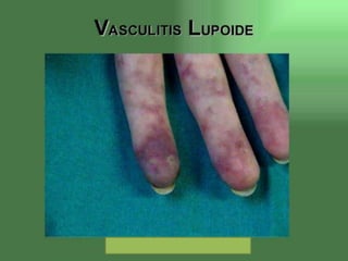 Lupus