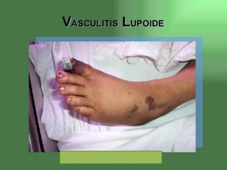 Lupus