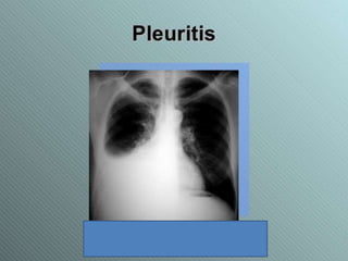 Lupus