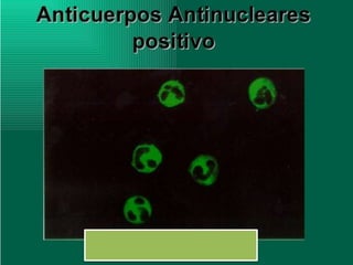 Lupus