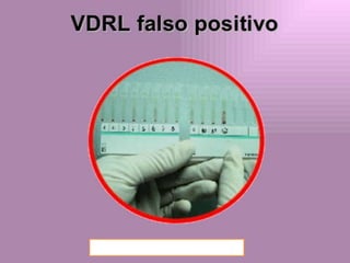 Lupus