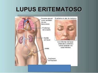 Lupus