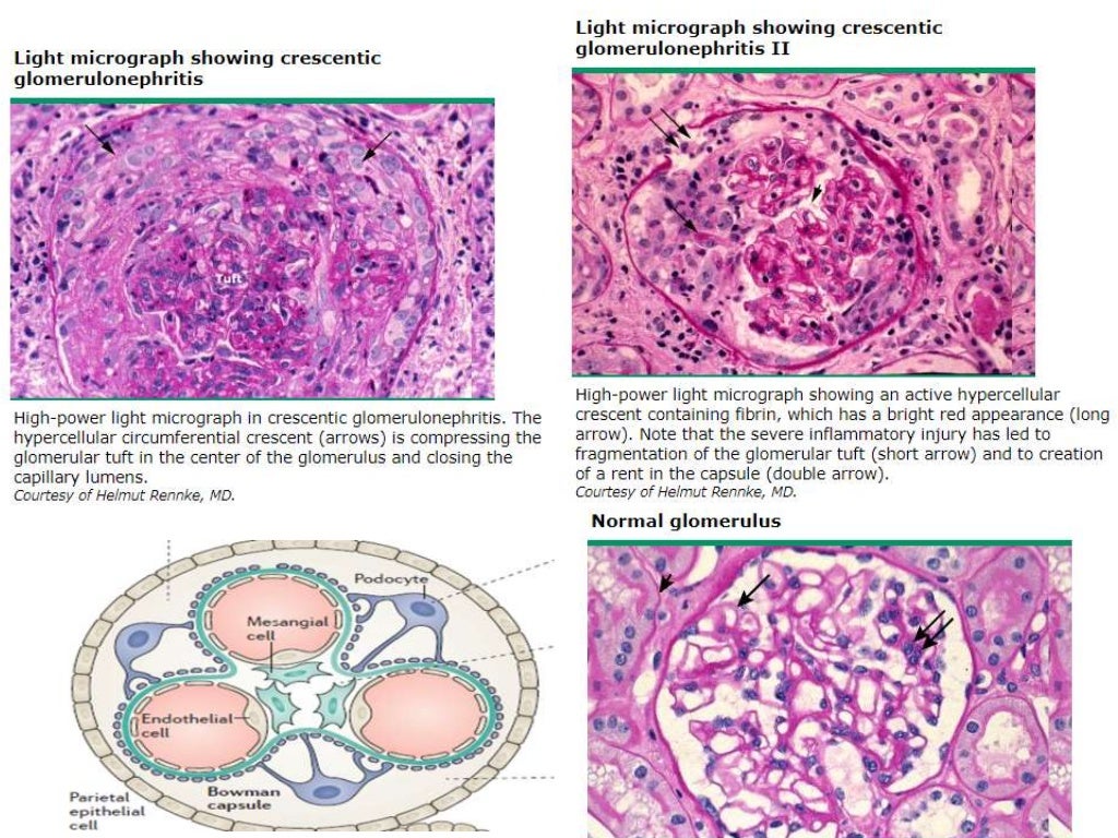 Lupus Nephritis From Basics To Practice