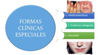 FORMAS
CLÍNICAS
ESPECIALES
L. medicamentoso
L. Cutáneo subagudo
L. neonatal
 