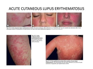 ACUTE CUTANEOUS LUPUS ERYTHEMATOSUS
 