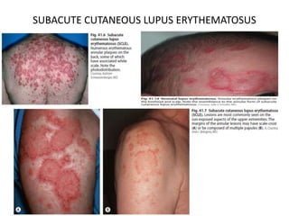 SUBACUTE CUTANEOUS LUPUS ERYTHEMATOSUS
 