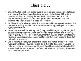 Classic DLE
• Classic DLE lesions begin as red-purple macules, papules, or small plaques
and rapidly develop a hyperkeratotic surface. Early classic DLE lesions
typically evolve into sharply demarcated, coinshaped (i.e., discoid)
erythematous plaques covered by a prominent, adherent scale that
extends into the orifices of dilated hair follicles.
• DLE lesions typically expand with erythema and hyperpigmentation at the
periphery, leaving hallmark atrophic central scarring, telangiectasia, and
hypopigmentation.
• When present on hair-bearing skin (scalp, eyelid margins, eyebrows), DLE
causes scarring alopecia, which can lead to disfigurement and markedly
impact quality of life. Follicular involvement in DLE is a prominent feature.
Keratotic plugs accumulate in dilated follicles that soon become devoid of
hair(adherent scale).
• DLE in Asian&Indians, can present clinically as isolated areas of macular
hyperpigmentation. DLE lesions can be difficult to diagnose in Caucasian
patients because the characteristic peripheral hyperpigmentation is often
absent. Such lesions are often confused with actinic keratoses, squamous
cell carcinoma, or acne.
 