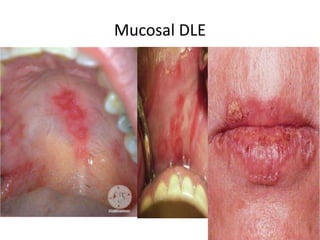 Mucosal DLE
 
