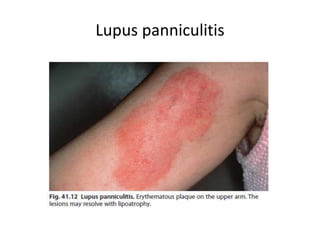 Lupus panniculitis
 